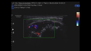 sarcoma della parete toracica [upl. by Dett]