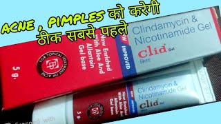 Clid gel for acne uses in hindi  clindamycin amp Nicotinamide gel review in hindi [upl. by Ahsini461]