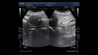 Hepatic Hydatid Cyst [upl. by Aloivaf]