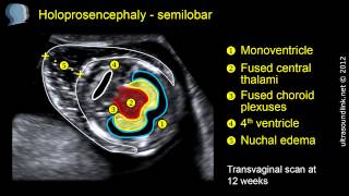 Semilobar holoprosencephaly 2D and 3D ultrasound [upl. by Tnomel]