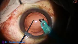 Double Rhexis Submarine Chop Epinucleus to protect P C in an Intumescent cataract Pradip Mohanta [upl. by Luigi]