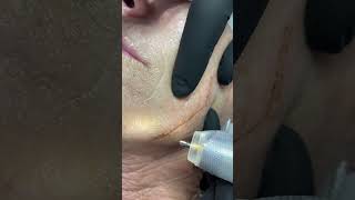 Plasma plasma skintightening [upl. by Whitford]