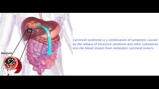 Carcinoid Syndrome [upl. by Rinum]