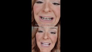 one year with clip in veneers from instasmile [upl. by Newell]