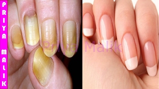 नाखूनों को सफ़ेद करने के लिए सबसे अच्छा तरीका Only in 10 minutes  How to Whiten your Yellow Nails [upl. by Ailana]