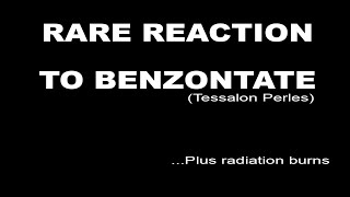 Unable to speak  Benzonatate Reaction [upl. by Philippe]