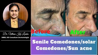 Senile Comedonessolar ComedonesPimples or blackheads in old ageacne treatmentblackheads removal [upl. by Annaul]