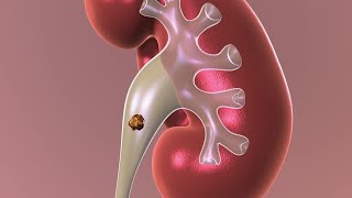 Observation Nonsurgical Approach to Kidney Stones [upl. by Sweeney]