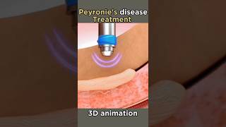 peyronies disease treatment shorts viral disease peyronies [upl. by Kryska652]