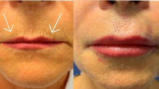 How to Get Rid of Wrinkles around Lips💋How to Get Plump LipsBiggerLipsFuller Lips [upl. by Keese]