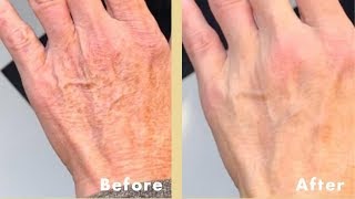 BEST Hand Cream For Aging Hands  Wrinkled Cracked Dry Hands REPAIRED [upl. by Ahtimat276]