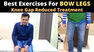 How to Recover Bow Legs Genu Varum Treatment for Bow legs Knee Osteoarthritis Treatment Knee OA [upl. by Sammer]