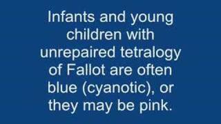 Tetralogy of fallot TOF [upl. by Rolecnahc]