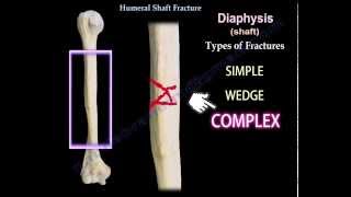 Humeral Shaft Fracture  Everything You Need To Know  Dr Nabil Ebraheim [upl. by Enaitsirk435]