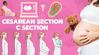 Csection animation  Cesarean section  Baby delivery animation [upl. by Anaes]