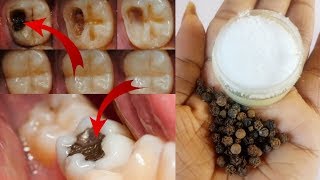 Cure tooth cavity just in one day  100 effective remedy for tooth ache  tooth pain home remedy [upl. by Nottap]