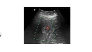 Achados clínicos ultrassonográficos e tomográficos típicos dos hemangiomas hepáticos [upl. by Shaffer]