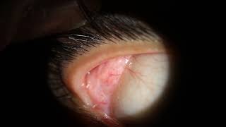 Dacryoadenitis Swollen Lacrimal Tear Gland  comes out of eye at 037 [upl. by Ingmar28]