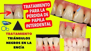 Tratamiento para la pérdida de Papila interdental 🦷 ▲ TRIÁNGULOS NEGROS EN LA ENCÍA con periomx [upl. by Wadleigh613]