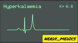 Electrocardiography  ECG changes in HYPERKALEMIA [upl. by Milton]