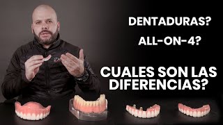 Dentaduras vs Sobre Dentaduras vs Allon4 Implantes Dentales [upl. by Cam]