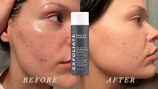 How to properly use the Paulas Choice 2 BHA Liquid Exfoliant  Dos and Donts [upl. by Halonna177]