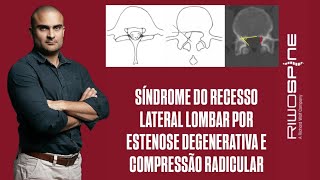 09112024  IL L5S1  SÍNDROME DO RECESSO LATERAL POR HÉRNIA DISCAL CALCIFICADA EM PACIENTE OBESO [upl. by Rainah]