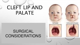 CLEFT LIP PALATESURGICAL CONSIDERATIONS dentabest4493 [upl. by Hoagland]