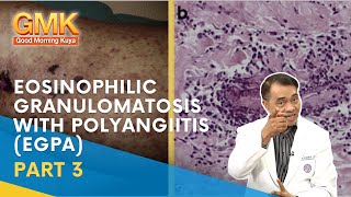 Eosinophilic Granulomatosis with Polyangiitis EGPA Part 3  Usapang Pangkalusugan [upl. by Anaihk305]