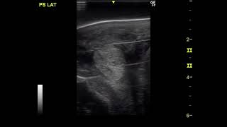 Dr Riccio  Low Frequency Ultrasound Treatment of Suspensory Ligament Branches Desmitis  Video 2 [upl. by Uno886]