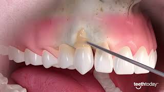 Mastering Gum Recession Treatment Advance Dental Implant and TMJ Center [upl. by Monagan]