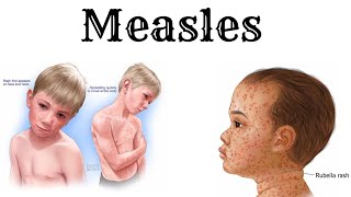 Everything about MEASLES in detail and simple [upl. by Novaelc]