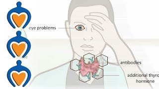 Thyroid problems  most common thyroid problems symptoms and treatment [upl. by Adamina]