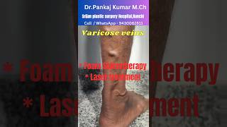 Varicose veins treatment for SSC GD medical Best varicose veins treatment shorts varicoseveins [upl. by Enywad]