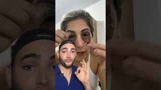 Peeling de Fenol en el contorno de Los ojos skincare beauty [upl. by Daggett124]