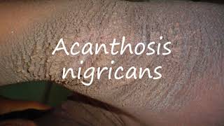 How to Pronounce Acanthosis nigricans [upl. by Burk]