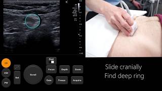 Ultrasound Tutorial InguinalFemoral Hernia Assessment  Radiology Nation [upl. by Annayd805]