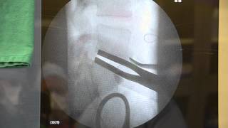 Lumbar Artificial Disc Replacement Surgery Synthes ProdiscL [upl. by Taveda752]