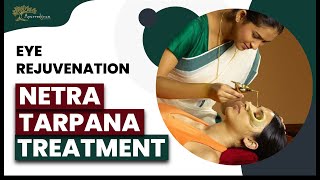 Netra Tarpana The Ayurvedic Treatment for Eye Nourishment  Ayurvedgram [upl. by Remot]