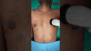 Gynecomastia cure  Dressing removal amp RF Session shorts [upl. by Ebarta]