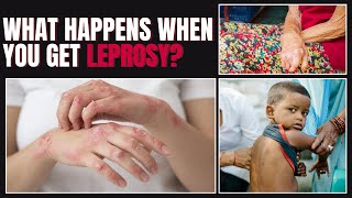 Leprosy Symptoms Types and Whos at Risk Everything You Need to Know [upl. by Intosh388]