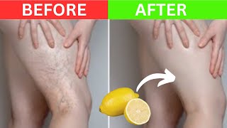 Dont Ignore This Natural Remedy erases your Varicose Veins [upl. by Sheng]