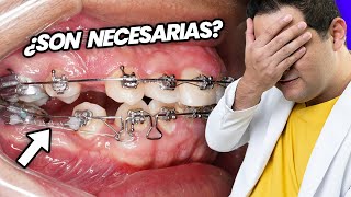 ¡La GUERRA de las EXTRACCIONES de PREMOLARES ¿SACAR DIENTES Es NECESARIO para tu TRATAMIENTO [upl. by Stockwell]