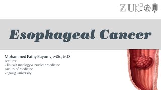 Esophageal Cancer [upl. by Georgeta562]