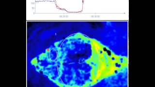 Cardiac Arrest  Perfusion Measurement in Brain [upl. by Nwotna283]