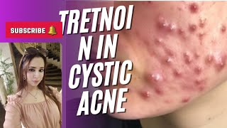 Use of isotretinoin in cystic acne [upl. by Nowahs]