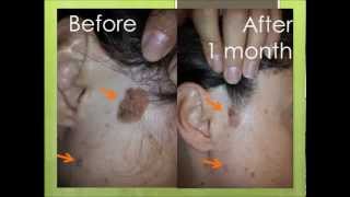 Natural treatment for seborrheic keratosis before and after photos [upl. by Hospers748]