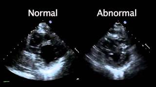 Echocardiogram from the Patient Compared with That from a Normal Control  NEJM [upl. by Beitris585]