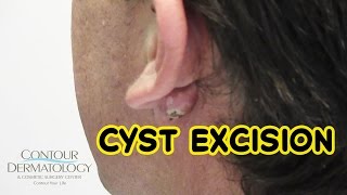 Stubborn Reoccurring Cyst Needs Removal [upl. by Steddman523]