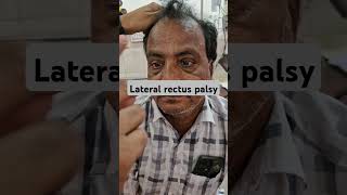 Lateral rectus muscle paralysisCN 6th Nerve palsydoctor ophthalmologynervedisorders [upl. by Aihsas]